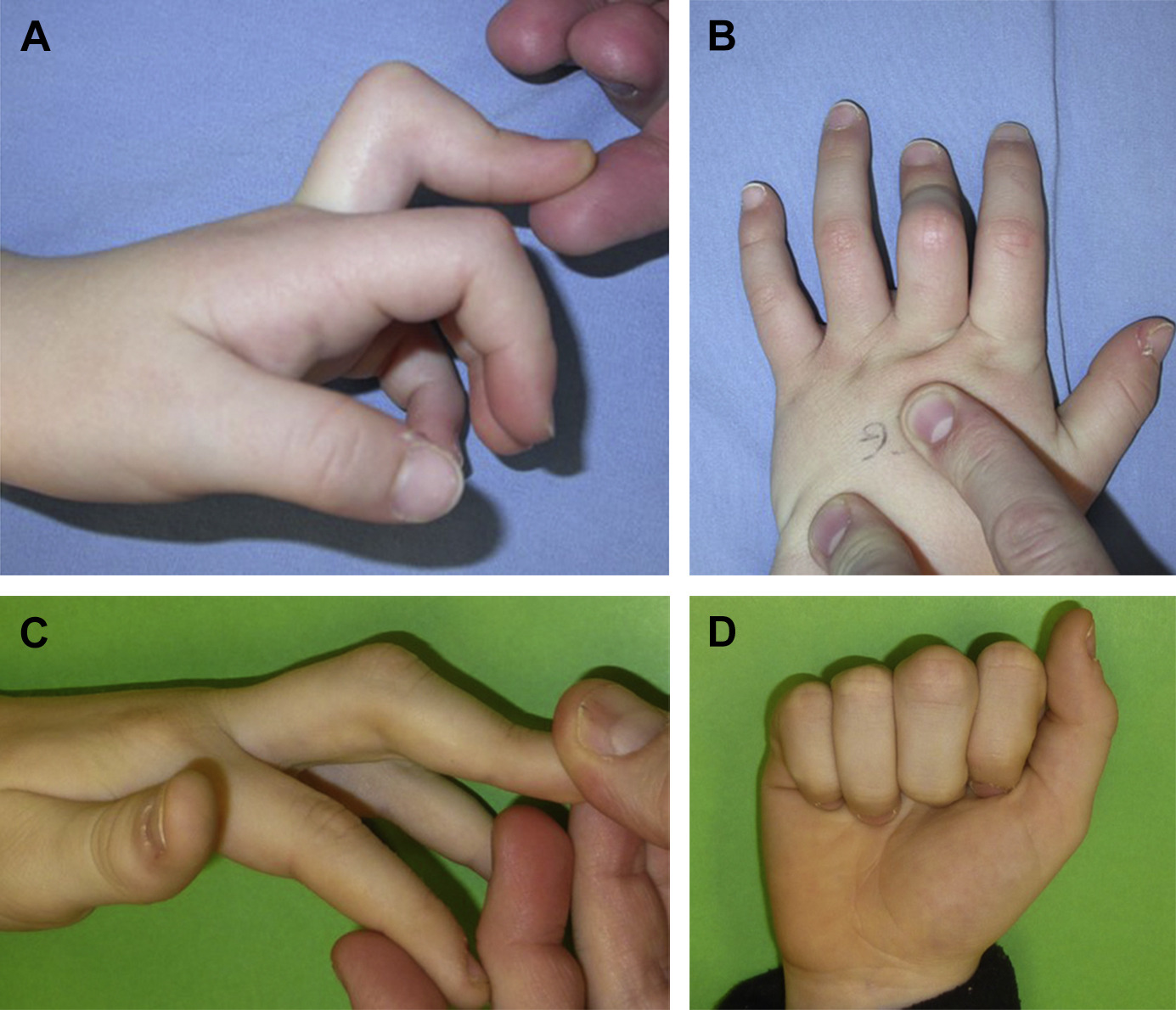 FINGER DEFORMITY